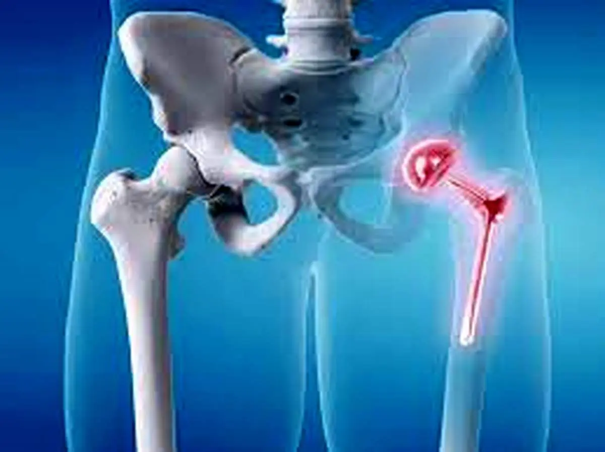 مراقبت های بعد از عمل تعویض مفصل لگن
