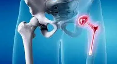 مراقبت های بعد از عمل تعویض مفصل لگن
