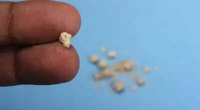 وقتی ناف هم مثل کلیه و صفرا سنگ  میسازد