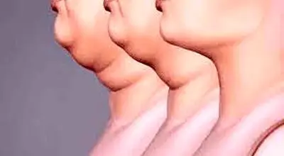 غبغب چیست و چطور آن را از بین ببریم؟