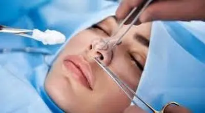 زمان مناسب برای شروع ورزش بعد از جراحی بینی
