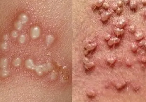 زگیل در باشگاه؛ اشتباهی ساده که خطر ابتلا را چند برابر می‌کند