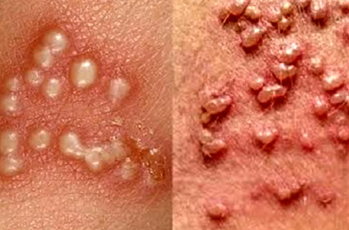 دشمن زگیل تناسلی چیست؟ آشنایی با راه های پیشگیری از زگیل تناسلی