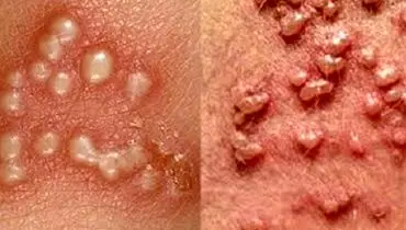 دشمن زگیل تناسلی چیست؟ آشنایی با راه های پیشگیری از زگیل تناسلی