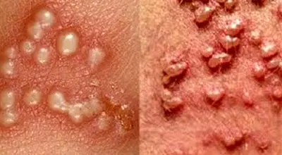 دشمن زگیل تناسلی چیست؟ آشنایی با راه های پیشگیری از زگیل تناسلی