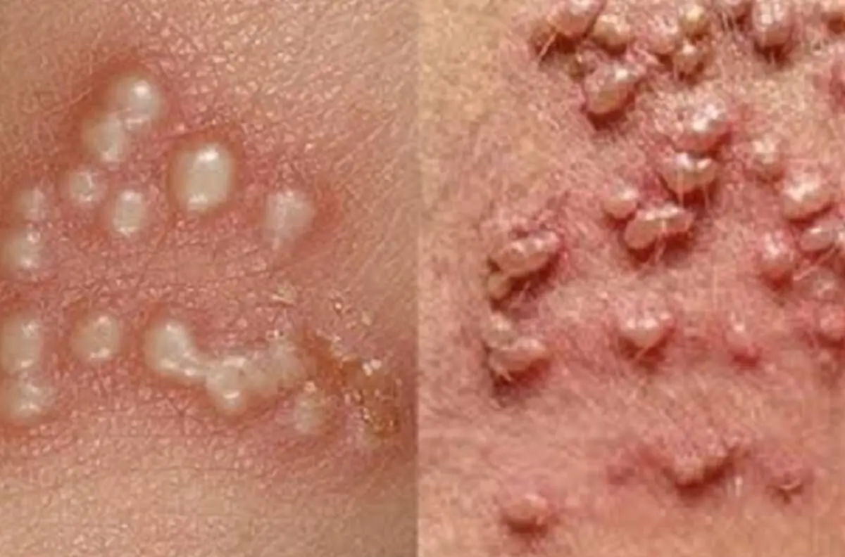دشمن زگیل تناسلی چیست؟ آشنایی با راه های پیشگیری از زگیل تناسلی
