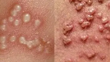 دشمن زگیل تناسلی چیست؟ آشنایی با راه های پیشگیری از زگیل تناسلی