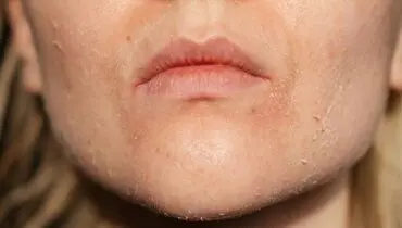 کدام نشانه پوستی  نشانه بیماری صفرایی است؟ 