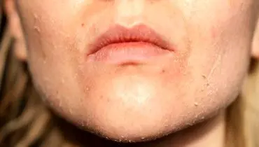 چطور خشکی پوست را در سرمای هوا درمان کنیم؟
