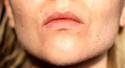 چطور خشکی پوست را در سرمای هوا درمان کنیم؟
