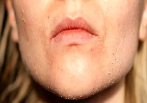 این عوامل باعث تشدید خشکی پوست شما می‌شوند
