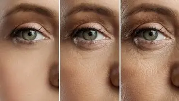 تکنیک طلایی برای درمان پیرچشمی
