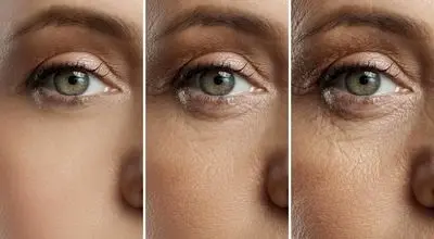 تکنیک طلایی برای درمان پیرچشمی