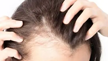 جلوگیری از ریزش مو به روش طب سنتی