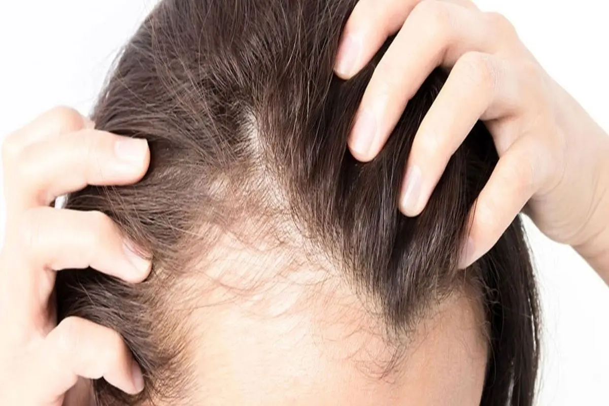 جلوگیری از ریزش مو به روش طب سنتی
