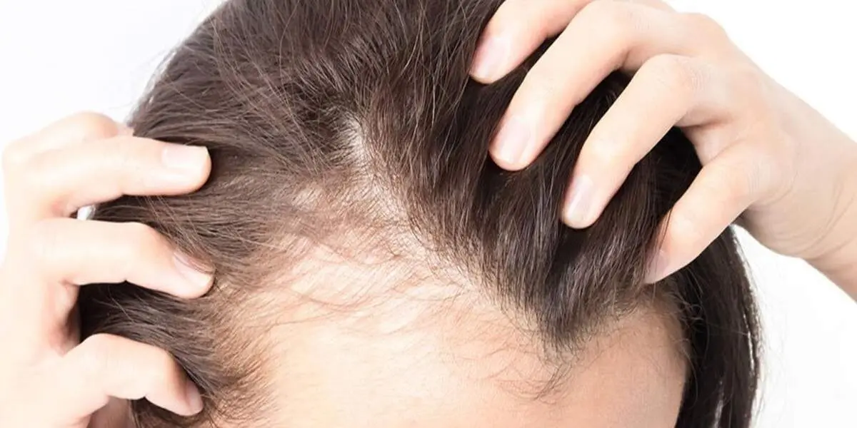 جلوگیری از ریزش مو به روش طب سنتی