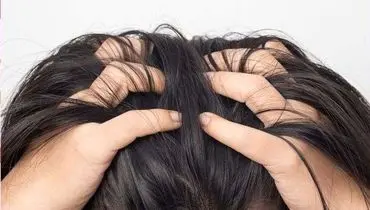 علت درد موی سر چیست؟