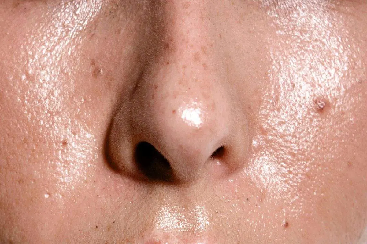 بهترین راهکار کنترل چربی پوست در تابستان