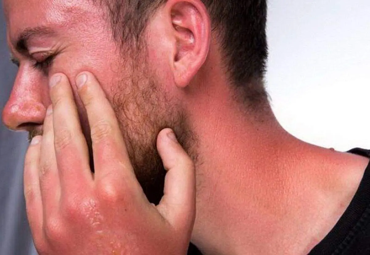 چطور جلوی آفتابسوختگی را بگیریم؟