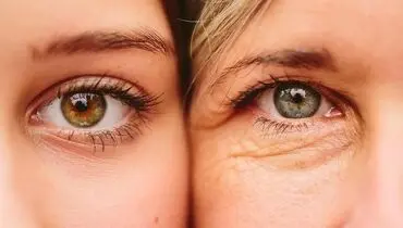 برای جلوگیری از چروک دور چشم چه کنیم؟