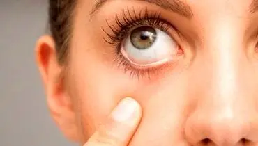 علائم و راهکار درمان بیماری خشکی چشم