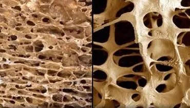 چگونه از شر پوکی استخوان راحت شویم؟