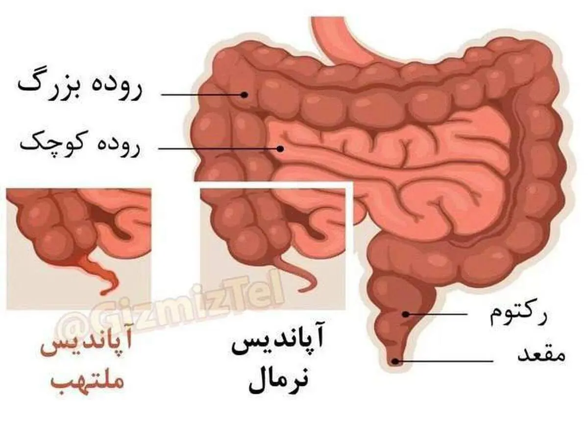 آپاندیس آنقدرها که فکر می کنید بی خاصیت نیست!