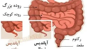 آپاندیس آنقدرها که فکر می کنید بی خاصیت نیست!