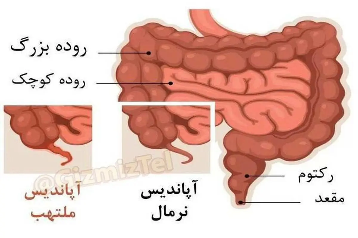 آپاندیس آنقدرها که فکر می کنید بی خاصیت نیست!