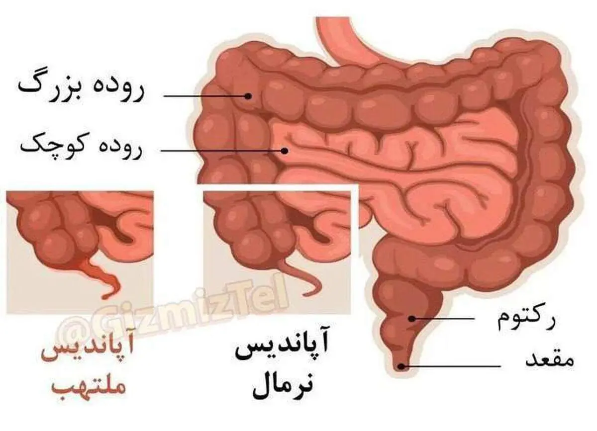 آپاندیس آنقدرها که فکر می کنید بی خاصیت نیست!