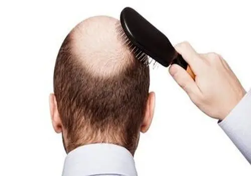 ۶ دلیل که سبب ریزش موها می‌شود