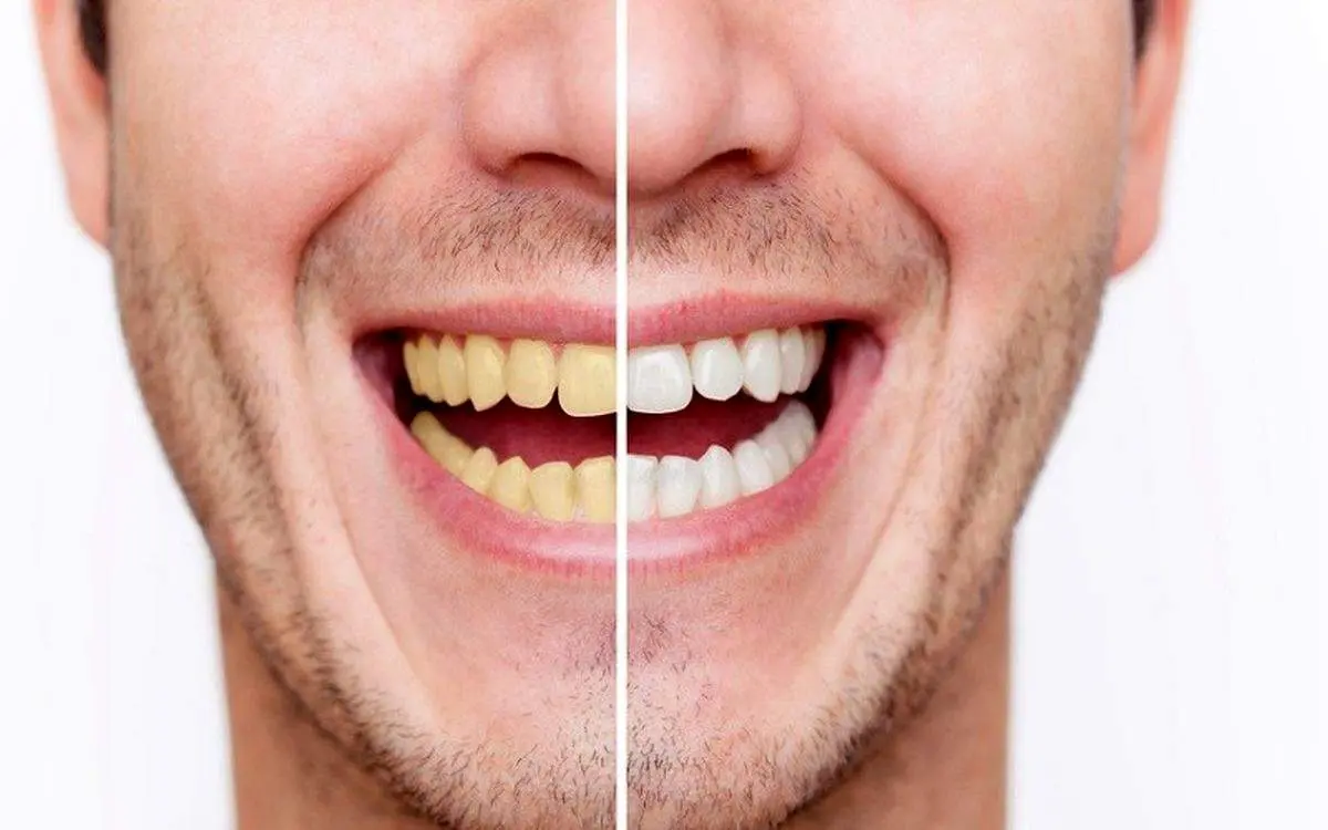 این اشتباهات رایج باعث زردی دندانها میشود