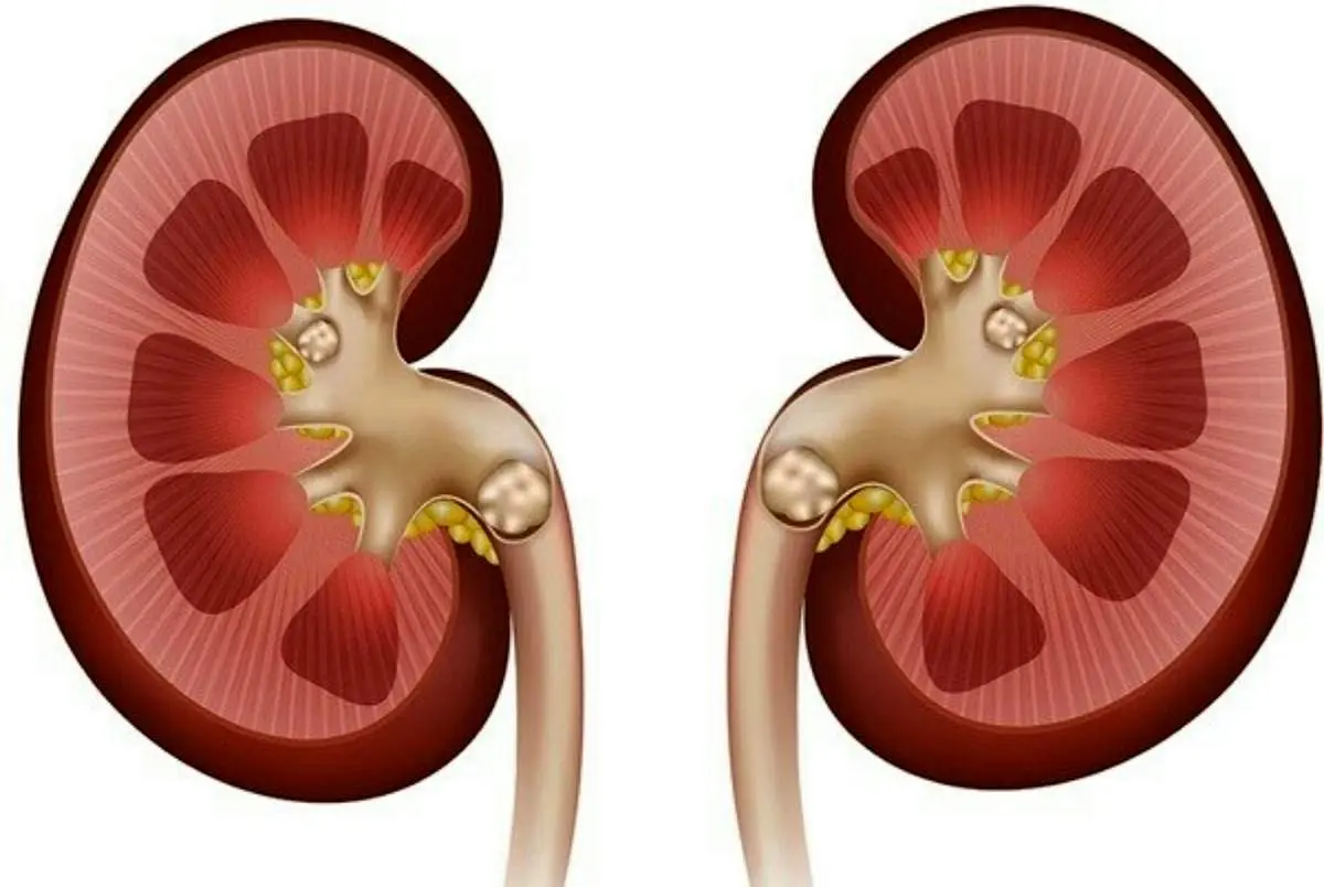 علائم به خطر افتادن کلیه را بشناسید