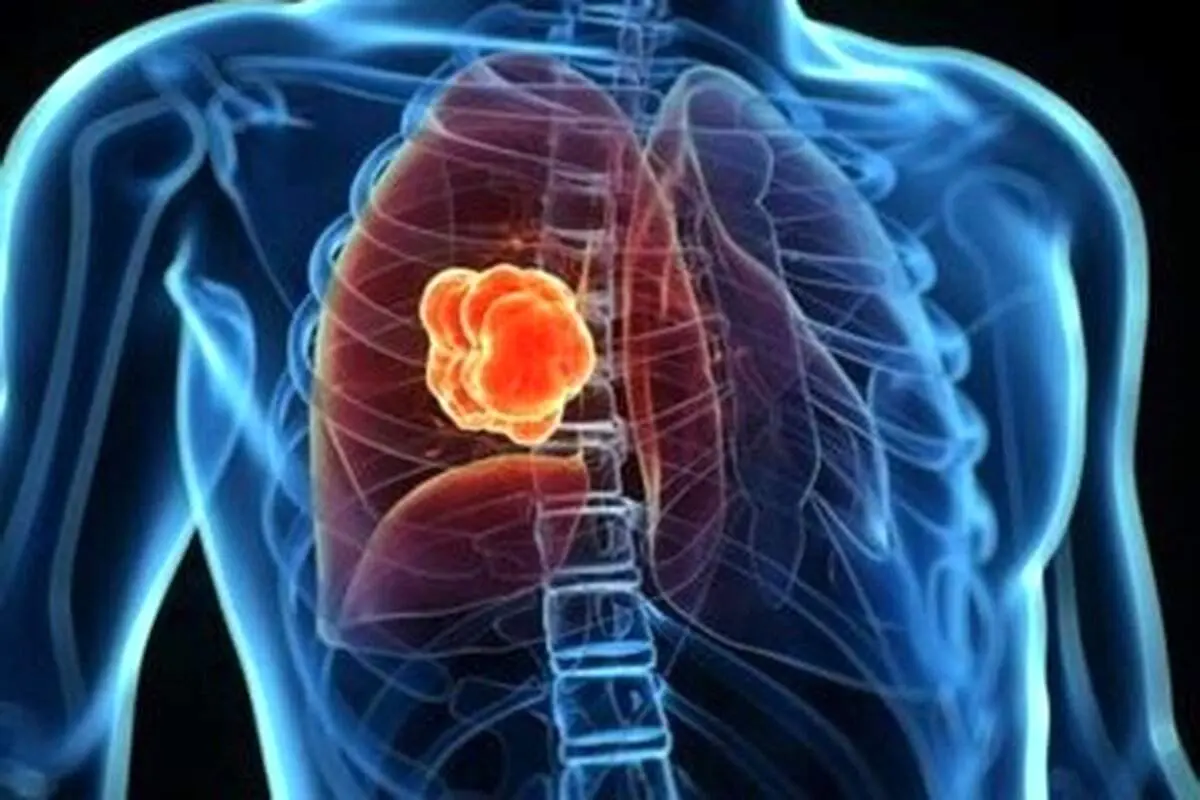 این بیماری مخوف سالانه یک میلیون کودک را به کام مرگ می برد!