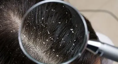 چه زمانی شوره سر می تواند خطرناک باشد؟
