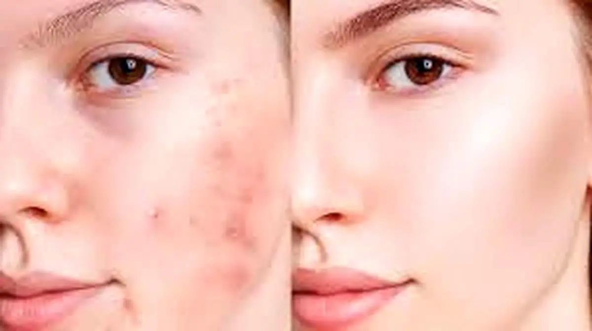 درمان و از بین بردن جوش صورت با روش های موثر