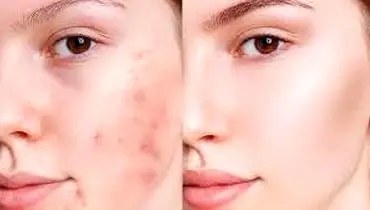 درمان و از بین بردن جوش صورت با روش های موثر