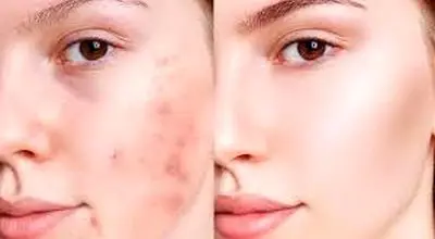 درمان و از بین بردن جوش صورت با روش های موثر