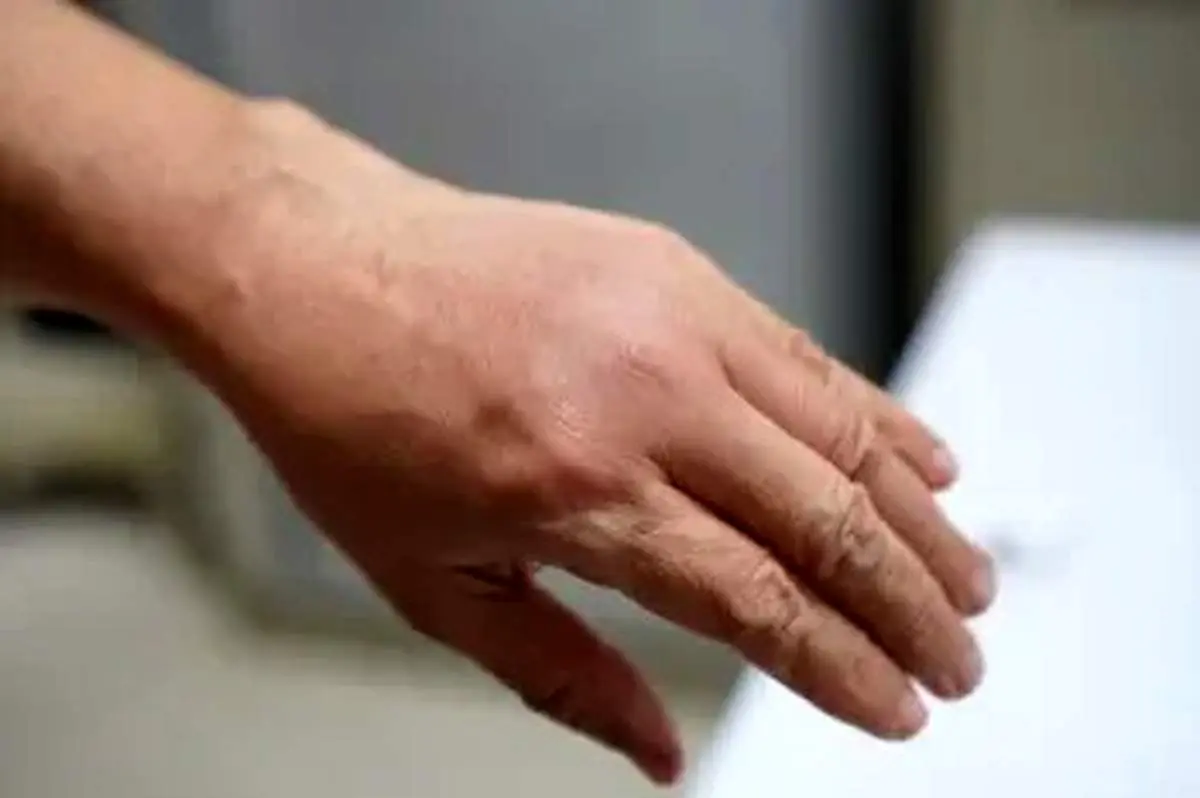 علت پیدا نشدن رگ دست: چرا و چگونه این مشکل رخ می دهد؟
