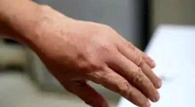 علت پیدا نشدن رگ دست: چرا و چگونه این مشکل رخ می دهد؟
