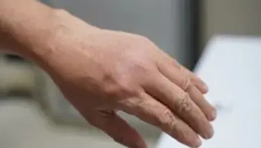 علت پیدا نشدن رگ دست: چرا و چگونه این مشکل رخ می دهد؟

