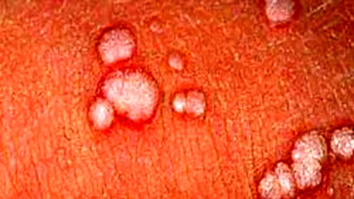 انواع زخم آلت تناسلی