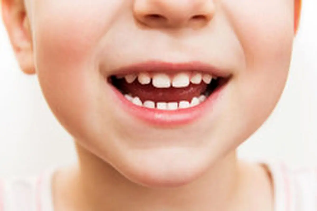 دندان عقل چه زمانی باید کشیده شود؟