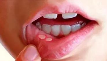 روشی جدید برای التیام آفت‌های دهان