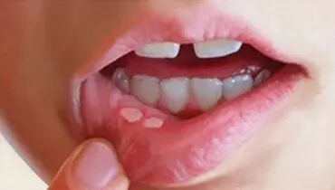 روشی جدید برای التیام آفت‌های دهان