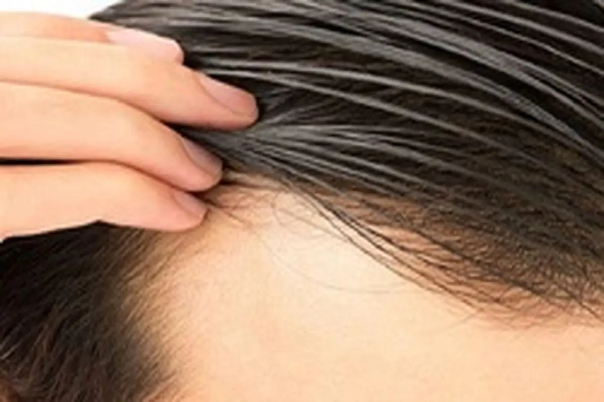 روش های از بین بردن چربی مو‌های سر