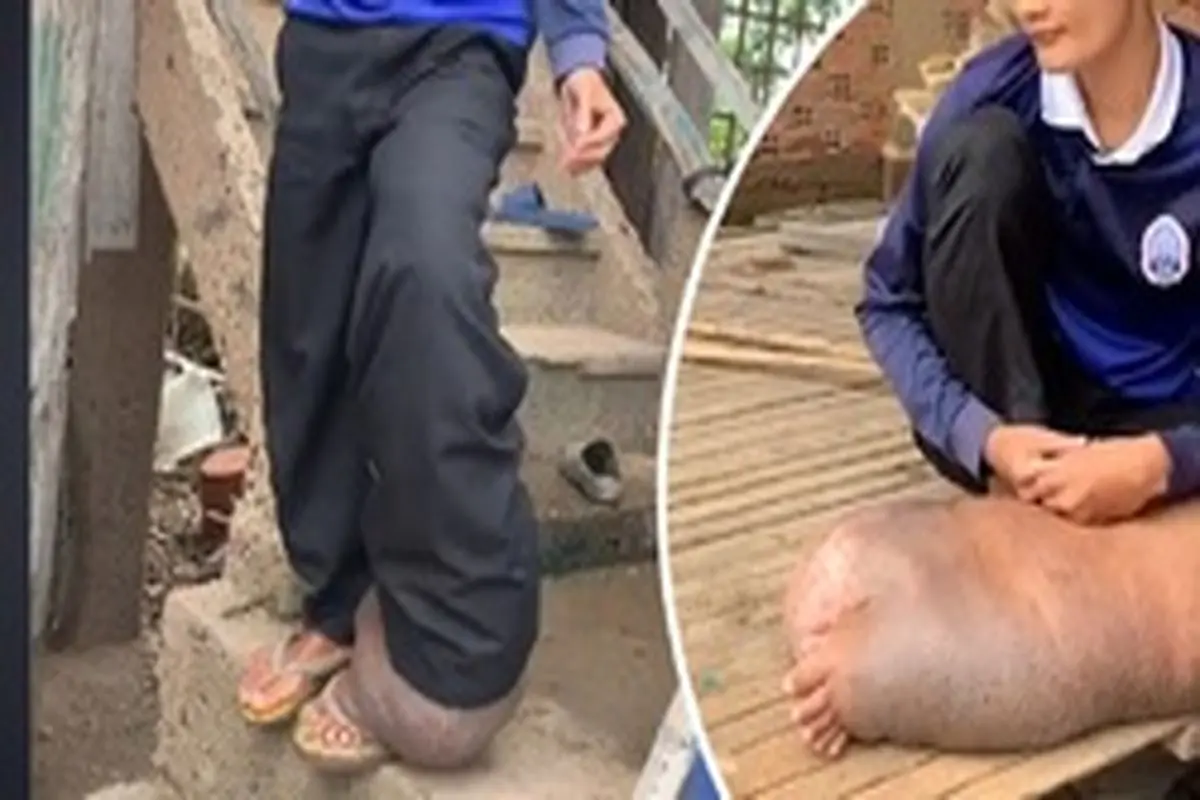 وضعیت عجیب پای پسر کامبوجی پس از گزش پشه! + عکس