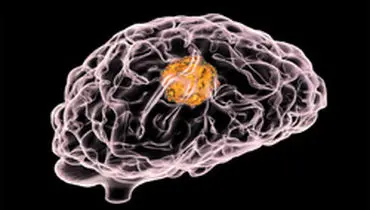 نشانه های ابتلا به تومور مغزی چیست؟