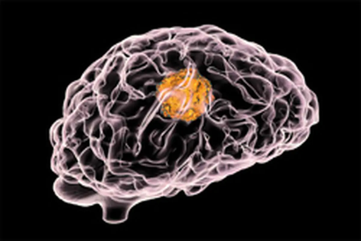 نشانه های ابتلا به تومور مغزی چیست؟