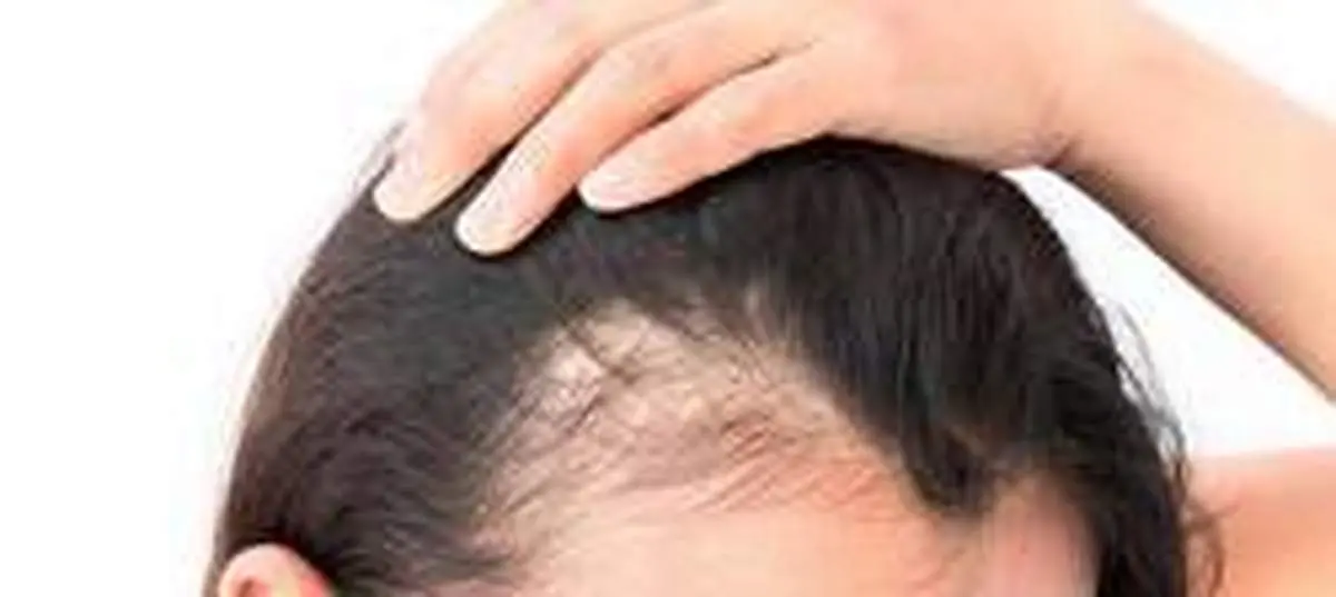 روش های کنترل ریزش موی ارثی